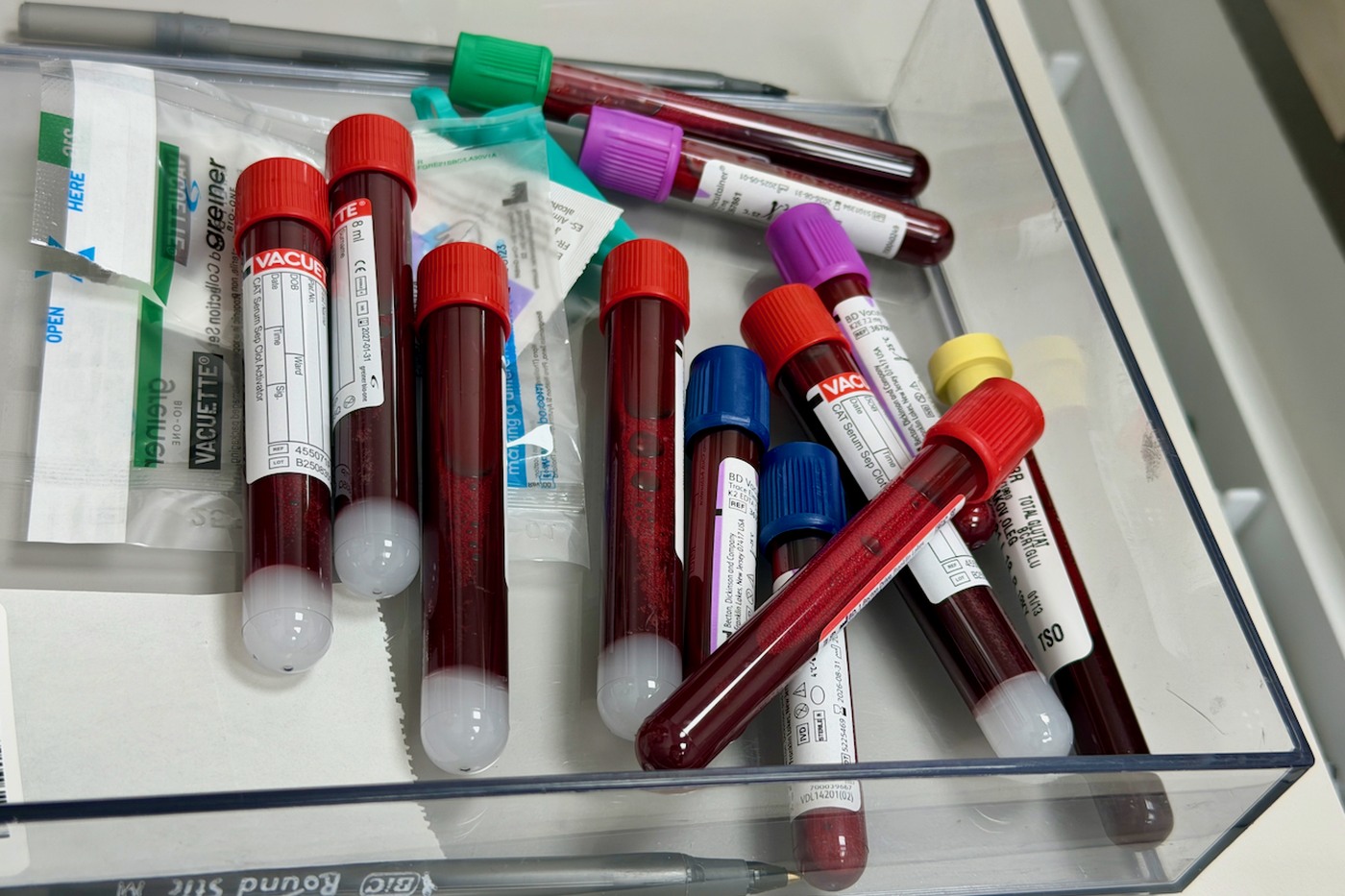 Дефіцит заліза: запаси феритину, синтез гемоглобіну та причини виснаження